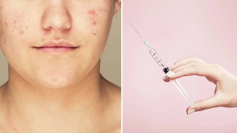 sivilceye karsi iki asi gelistiriliyor mrna denemesi ve enzim hedefli yaklasim jrAjtmrr