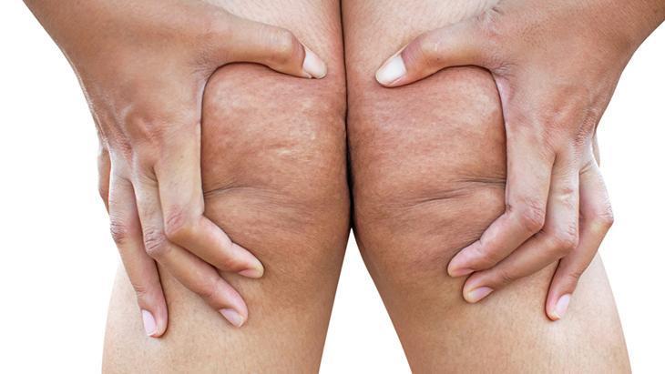 lipodem kadinlarin sessiz cigligi neden kilo veremiyorum diyenler icin cevap LuXTReCB.jpg